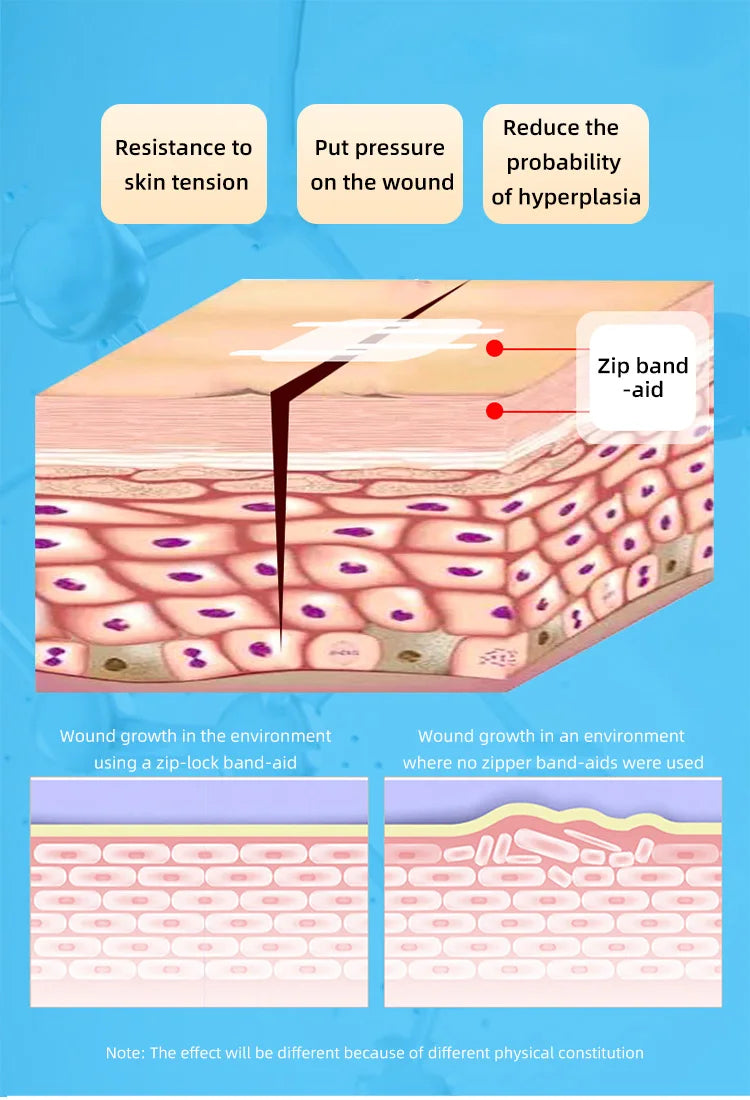 2pcs Zipper Tie Wound Closure Patch Hemostatic Patch Wound Fast Suture Zipper Band-Aid Outdoor Portable