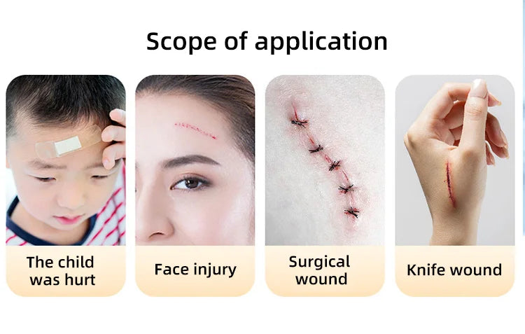 2pcs Zipper Tie Wound Closure Patch Hemostatic Patch Wound Fast Suture Zipper Band-Aid Outdoor Portable